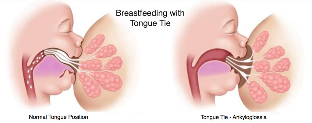 Breastfeeding-tongue-tie-infant-ankyloglossia